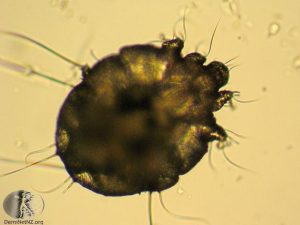 what does scabies look like?