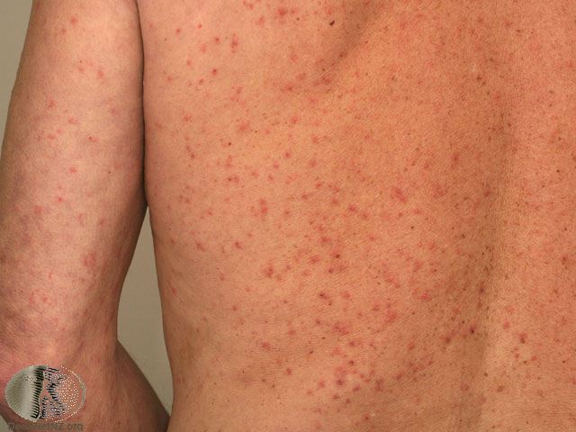 what does scabies look like?